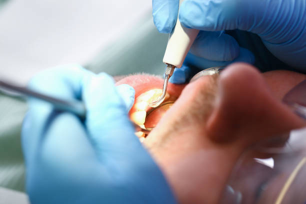 Best Chipped Tooth Repair Near Me  in Branson, MO